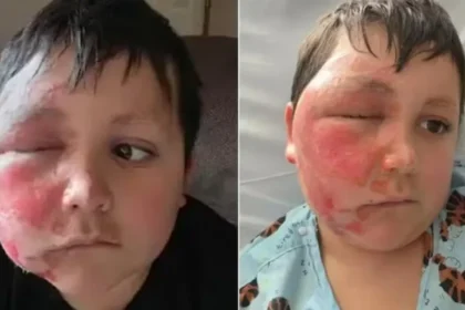Menino faz desafio do TikTok e acaba com rosto desfigurado