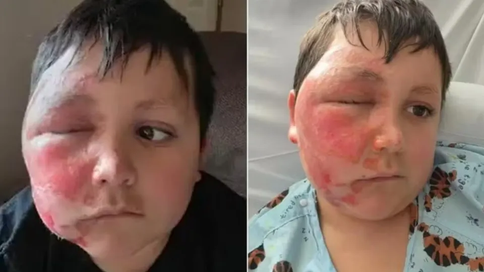 Menino faz desafio do TikTok e acaba com rosto desfigurado