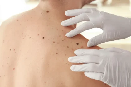 Casos de câncer de pele saltam de 4 mil para mais de 72 mil em 10 anos