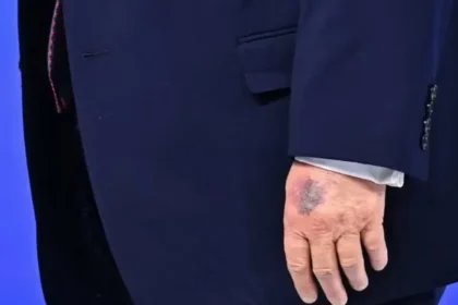 Hematoma misterioso na mão de Trump volta a chamar a atenção