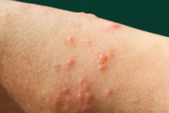 Mpox: nova recombinação de cepas é identificada pela OMS