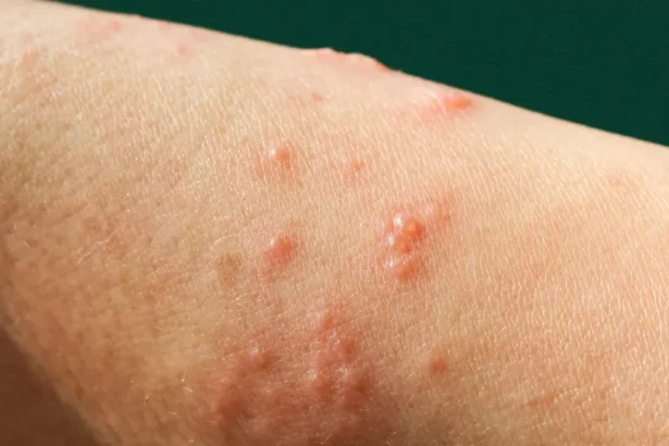 Mpox: nova recombinação de cepas é identificada pela OMS