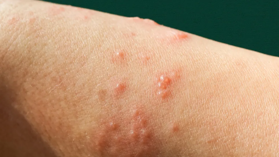 Mpox: nova recombinação de cepas é identificada pela OMS