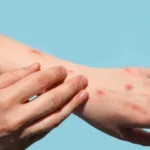 Brasil registra 48 casos de mpox nos primeiros meses de 2026