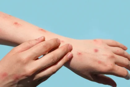 Brasil registra 48 casos de mpox nos primeiros meses de 2026