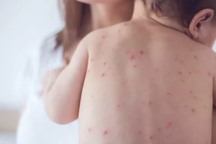 São Paulo tem primeiro caso de sarampo em 2026