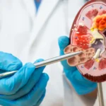 Doença renal avança no país e expõe gargalos de acesso à diagnóstico precoce e à diálise