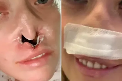 Mulher faz implante dentário e fica com ‘buraco’ no rosto: “Dói muito