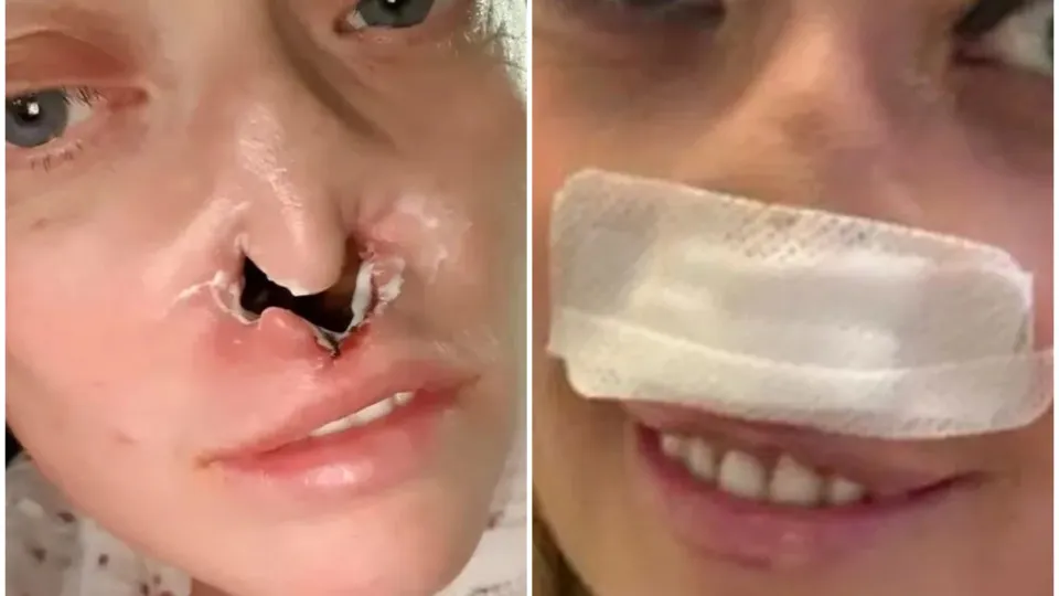 Mulher faz implante dentário e fica com ‘buraco’ no rosto: “Dói muito