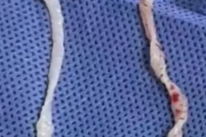 Mulher cozinhava rãs e acabou com dois parasitas de 10 cm no corpo