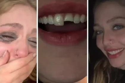 Jovem quebra dente na balada no PR, cola na madrugada e volta para a festa